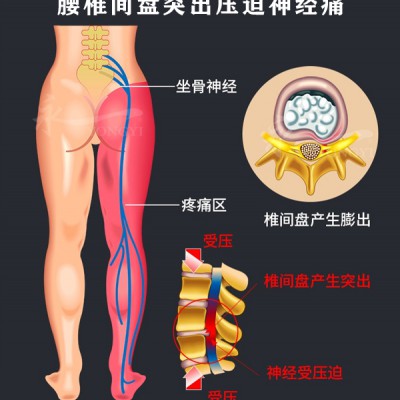 腰椎间盘突出压迫神经痛怎么治疗？用荣丰黑膏贴外敷！